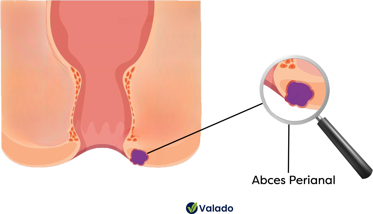Abces Perianal - Ilustratie Grafica