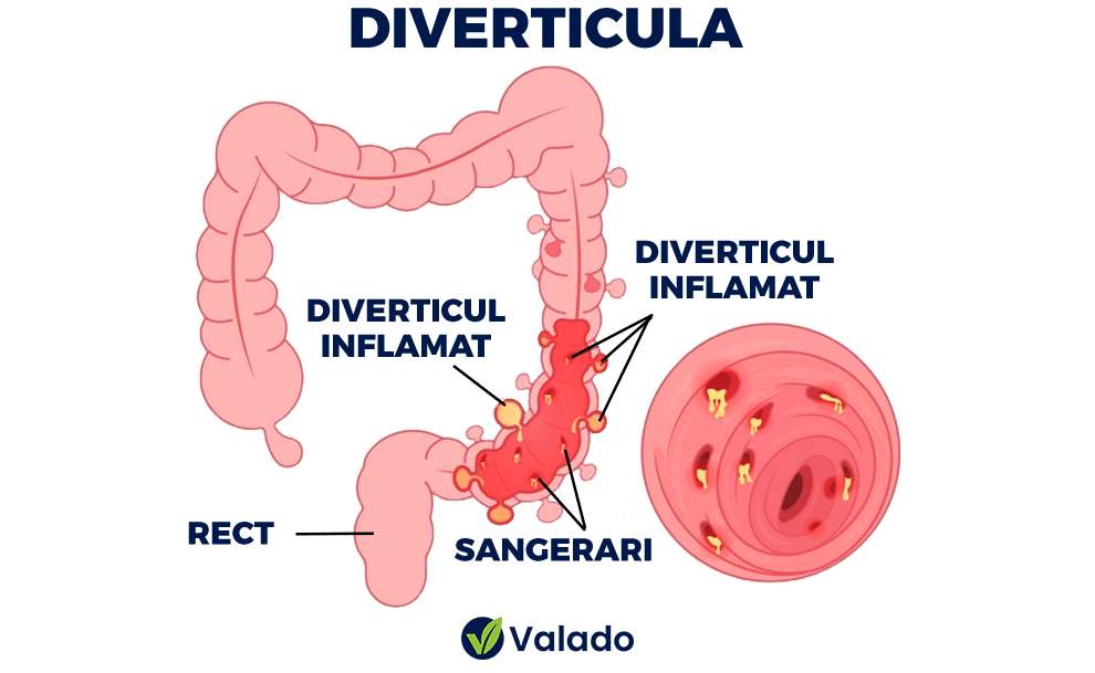 https://valado.ro/diverticulita/