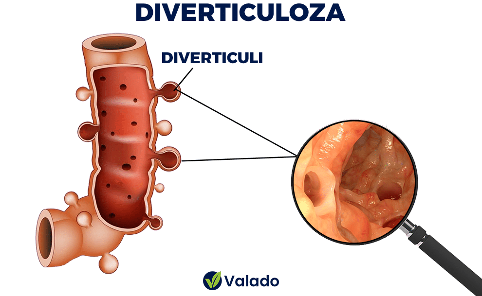 https://valado.ro/diverticuloza/